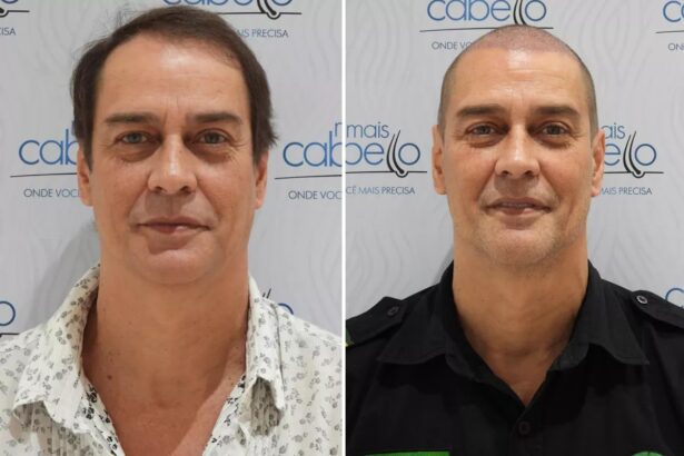 O antes e depois de Marcello Antony decorrente do transplante capilar