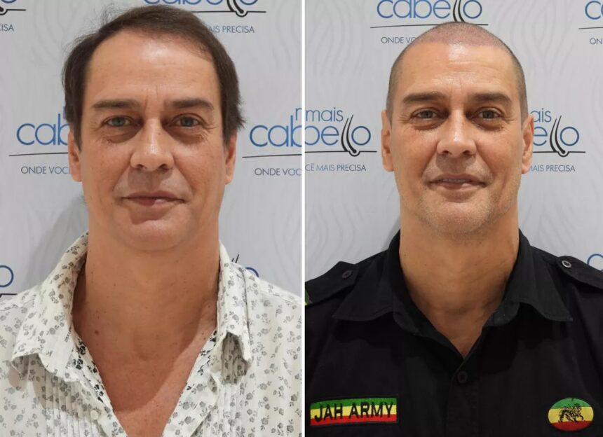 O antes e depois de Marcello Antony decorrente do transplante capilar