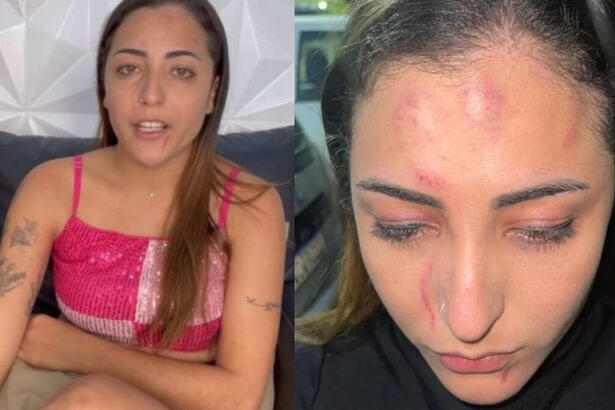 Cantora Banda Sedutora em uma montagem, com uma foto normal e outra com os ematomas da agressão