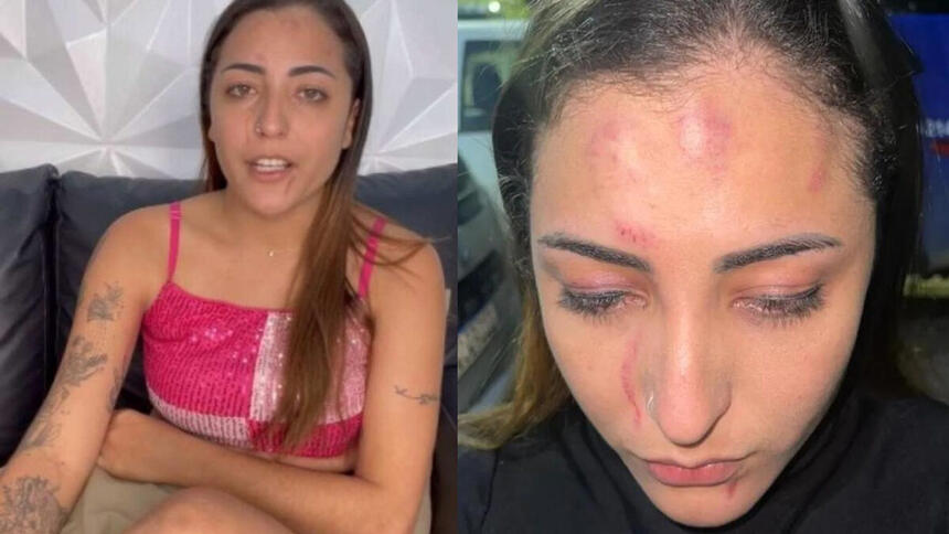 Cantora Banda Sedutora em uma montagem, com uma foto normal e outra com os ematomas da agressão