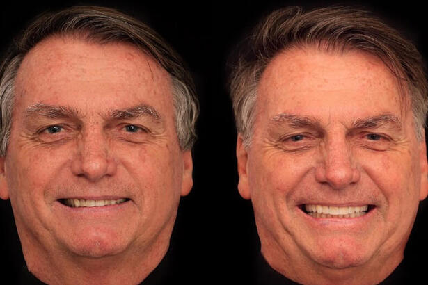 Faces de Bolsonaro antes e depois da harmonização facial