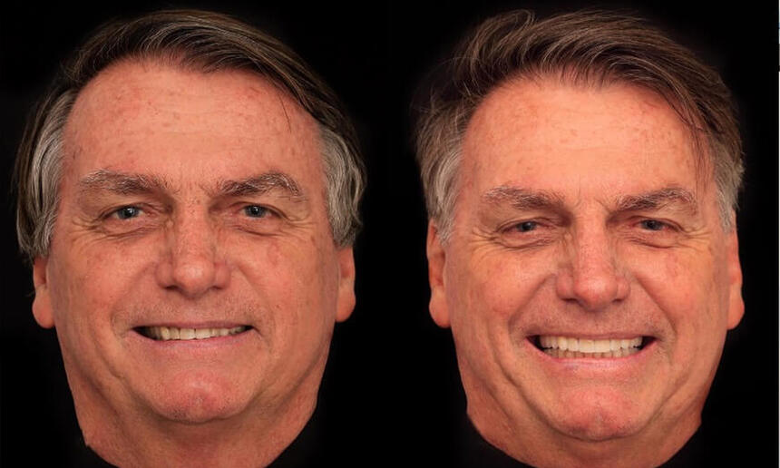 Faces de Bolsonaro antes e depois da harmonização facial