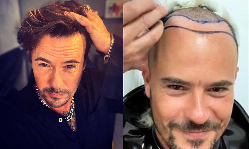 Imagem 1: Paulo Vilhena com a mão no cabelo; Imagem 2: Paulo Vilhena mostrando o processo de tratamento da calvície