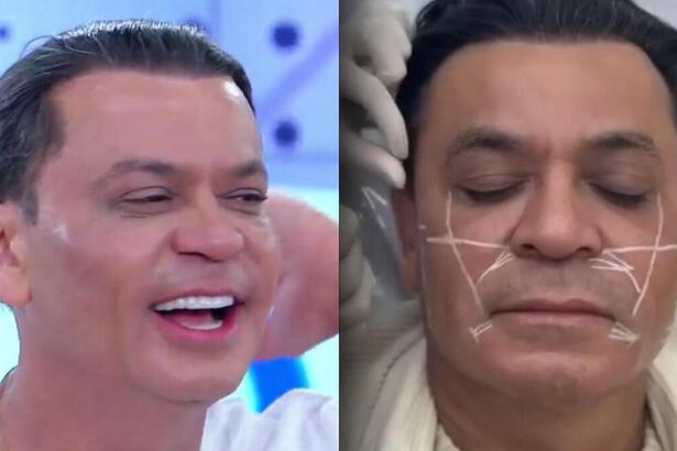 Antes e depois de Frank Aguiar que realizou nova harmonização facial