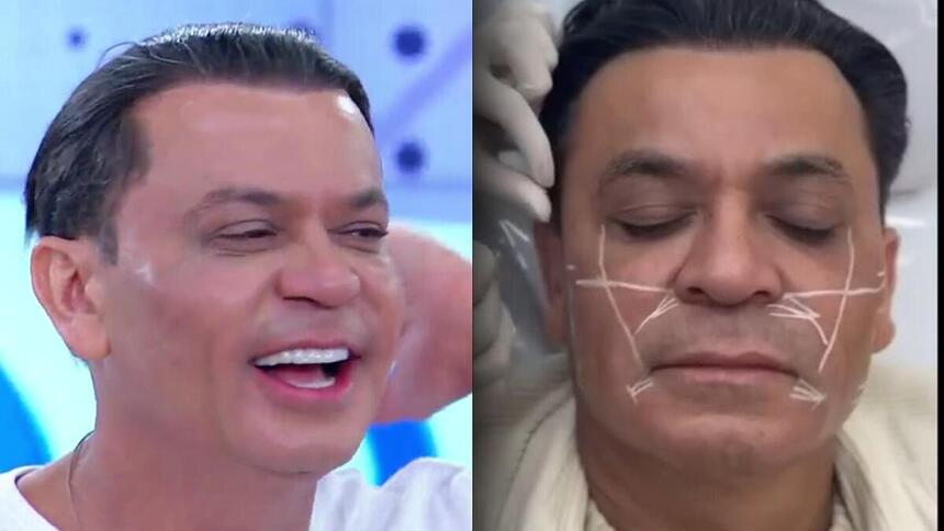 Antes e depois de Frank Aguiar que realizou nova harmonização facial