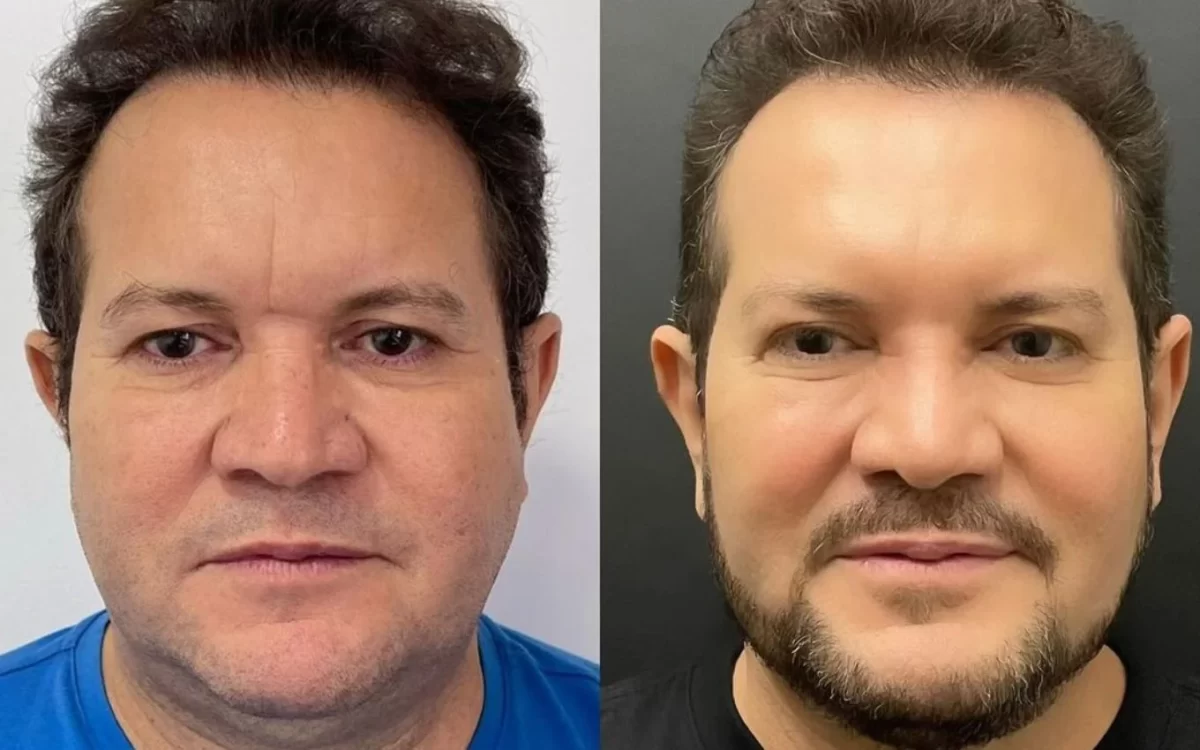 Harmonização facial de Ximbinha antes e depois