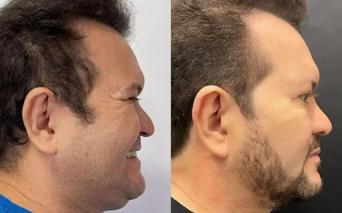 Harmonização facial de Ximbinha antes e depois