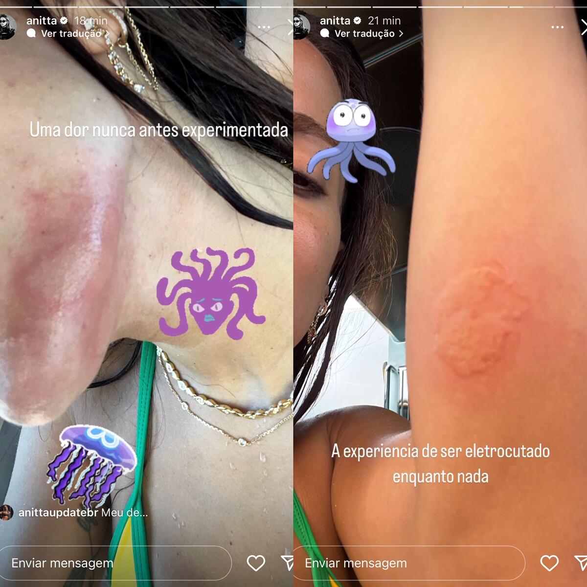 Anitta mostrando as marcas no rosto e no braço da água-viva