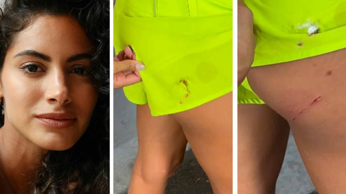 Letícia Salles mostrando as marcas de mordidas na perna e na roupa
