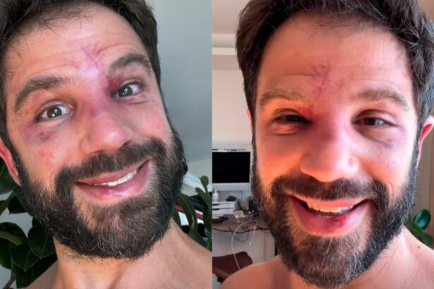 Duda Nagle sorrindo e mostrando hematomas