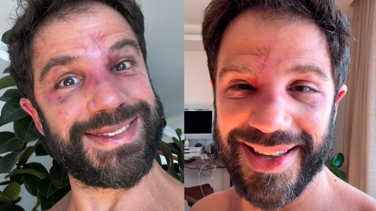 Duda Nagle sorrindo e mostrando hematomas