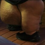 Close nas pernas de J.T. do programa "Quilos Mortais", mostrando inchaço e linfedema
