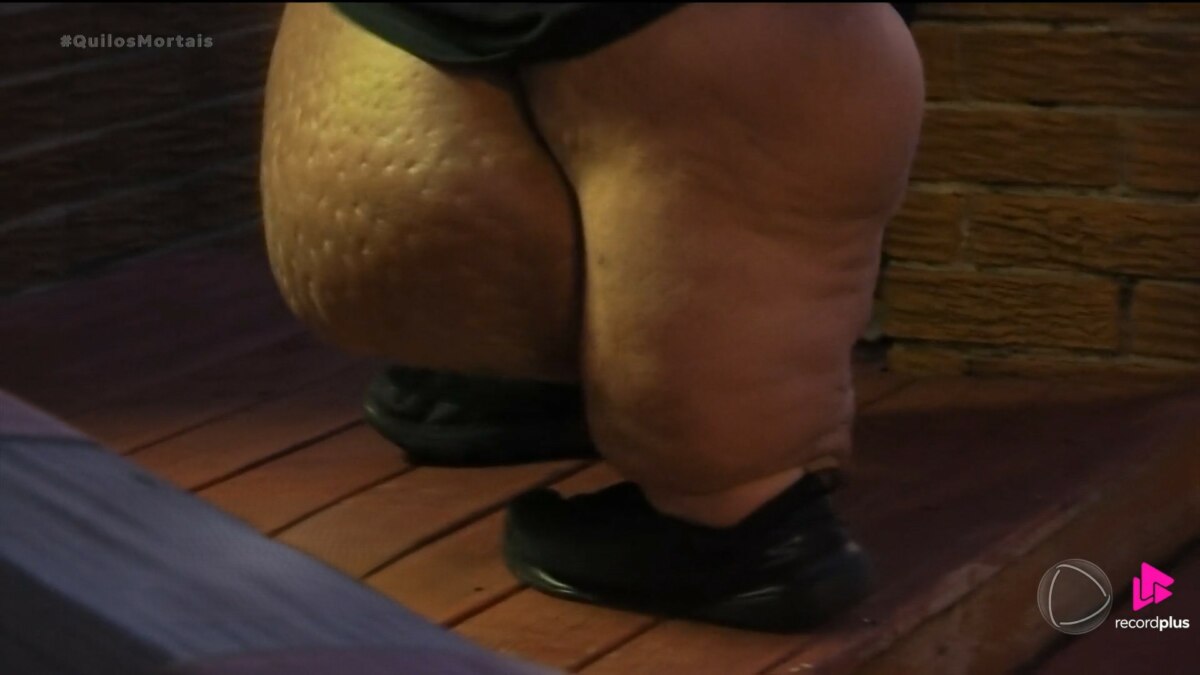 Close nas pernas de J.T. do programa "Quilos Mortais", mostrando inchaço e linfedema